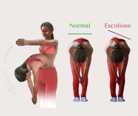 Escoliose idiopática: Saiba quando é preciso operar