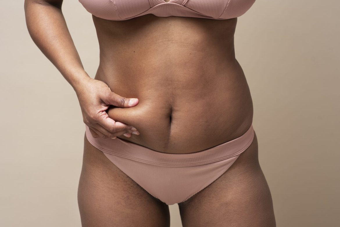 MILA-Abdominoplastia-Minimamente-Invasiva